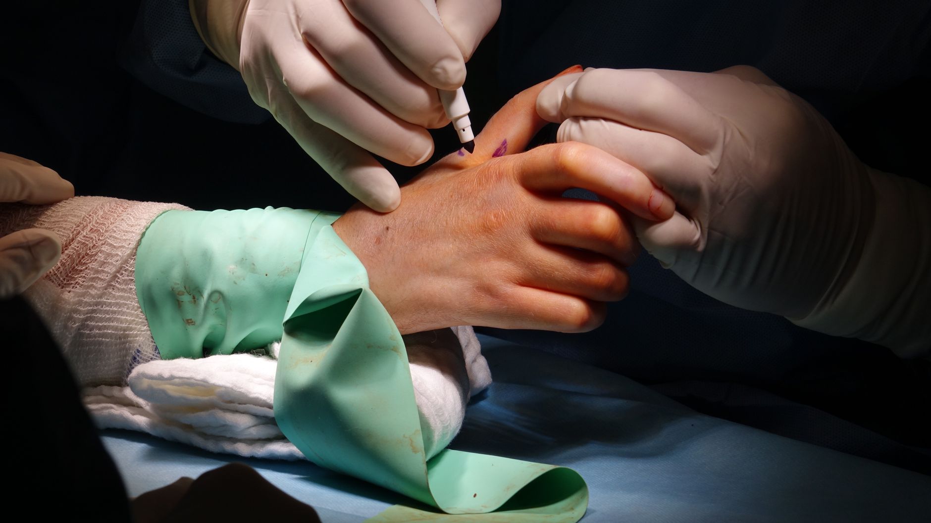 detail of surgical procedure on patient s wrist